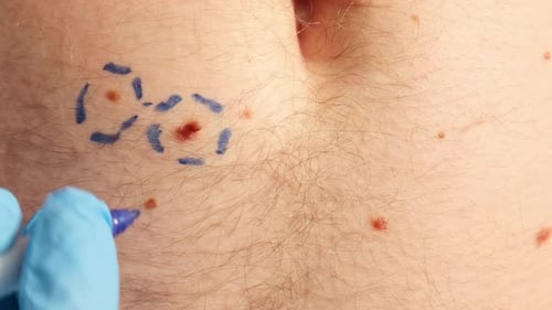 Close Up Mole Check With Blue Glove