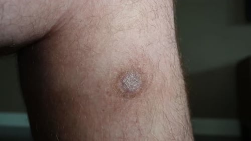 MRSA infection scar one year after large infection on the leg, super slow camera work top-down