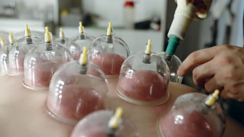 Closeup of a Cupping Therapy Session Showing Multiple Clear Suction Cups Attached to Back Skin While