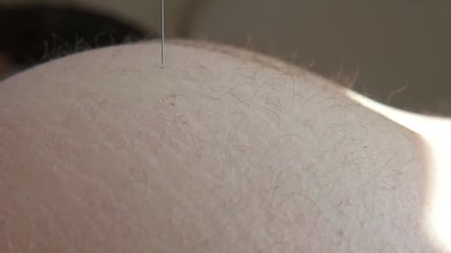 Needle Injecting Into the Muscle Nurse Doing a Trigger Point Injection in Patient Back Close Up