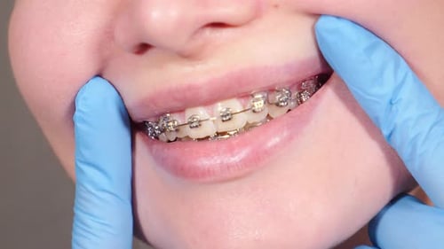 Orthodontic Treatment and Dental Care Happy Womanshowing Teeth with Braces Closeup Cropped Smiling