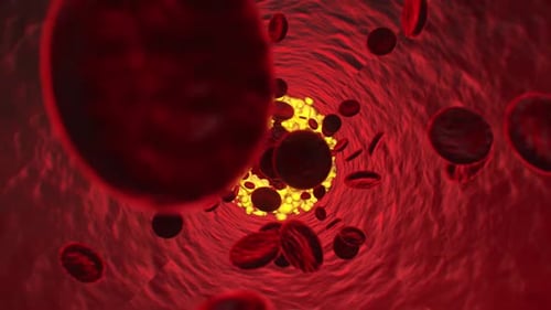 Clogged arteries, Cholesterol plaque in artery