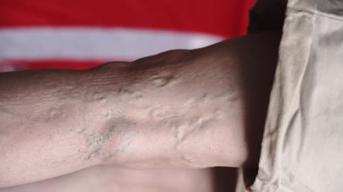 Primer plano de piernas de mujer madura con problema de venas varicosas