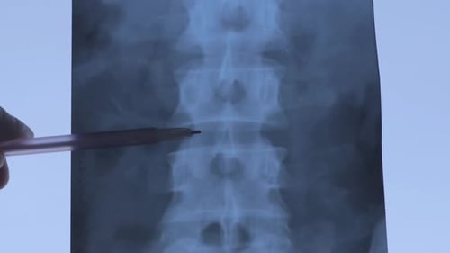 Medical Professional Analyzing Spine X-Ray with Pen