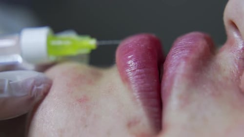 Adult Receiving Cosmetic Lip Injections Close Up