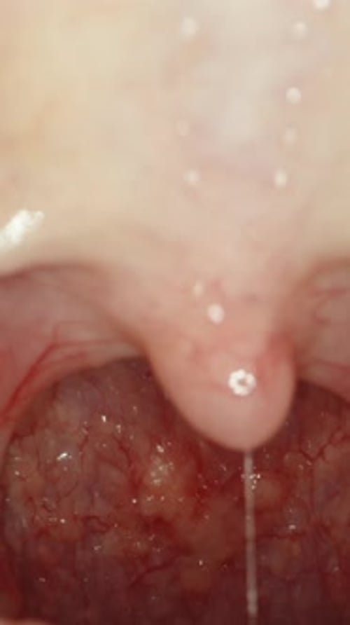 Verticale Gorge irritée et rougie d'une femme lors d'une maladie buccale. La sonde