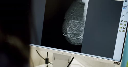 Doctor examine mammogram scan of female breast on computer screen in clinic