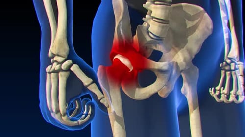 3D Animation of Human Hip Joint Pain