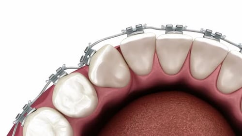 Orthodontic Braces Adjusting Teeth in Realistic 3D Medical Animation