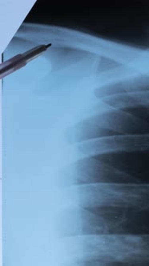 Examining Shoulder Bones on X-Ray