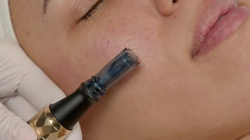 Close Up of Black Woman at Mesotherapy Procedure in Cosmetology Clinic