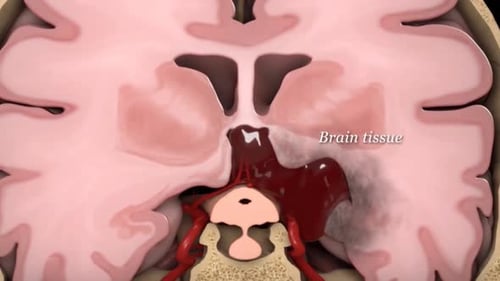 Detailed 3D Medical Animation of Brain Injury