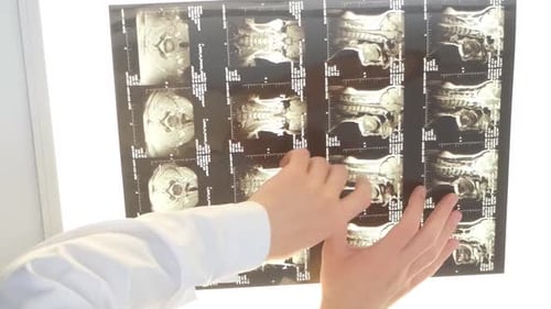 A Professional Vertebrologist Examines an Xray of a Female Patient's Spine in a Hospital