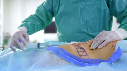 Plastic surgery operation in process.