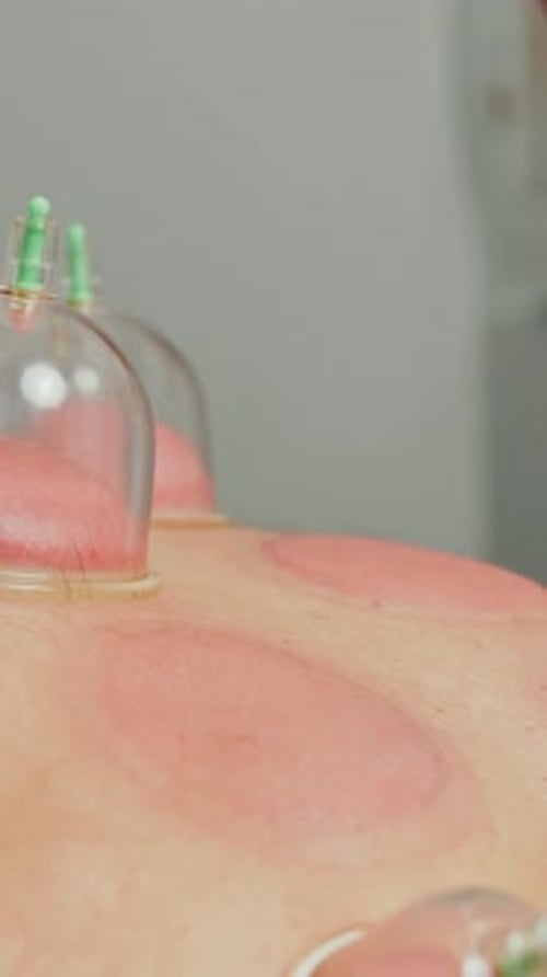 Cupping Therapy Treatment on Patient Back Close Up