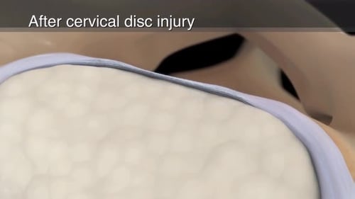 Cervical Disc Deterioration and Spinal Nerve Impingement Animation