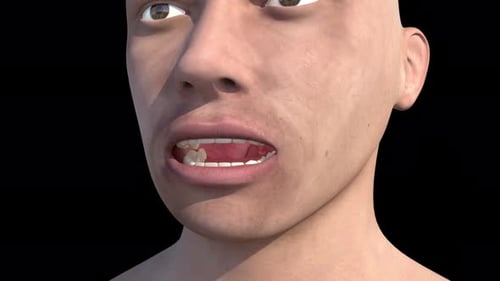 Medizinische Animation, die das Fortschreiten der menschlichen Tonsillitis in einem offenen Mund zeigt
