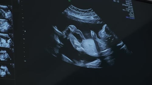 Ultrasound Sonogram of Fetus Actively Moving in Womb