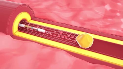 Blood Vessel Plaque Removal Medical Procedure Animation