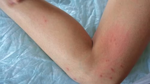 Kind kratzt am Körper empfindliche juckende Haut Körperausschlag Teenager-Allergie Nahaufnahme Teenager-Mädchen kratzt