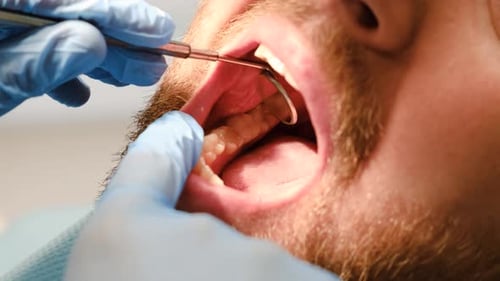 Close Up of Oral Cavity During Dental Treatment