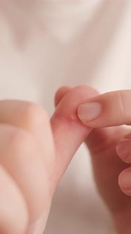 Close-up of a wart on a hand, a skin growth caused by HPV. A common ...