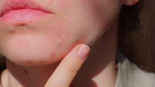 Woman Touching Acne on Her Face