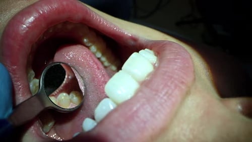 Dental Care Extreme Close Up Macro Video Dentist Treat Patient Teeth Orthodontist Works with