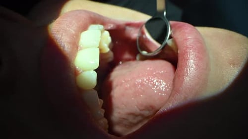 Dental Care Extreme Close Up Macro Video Dentist Treat Patient Teeth Orthodontist Works with