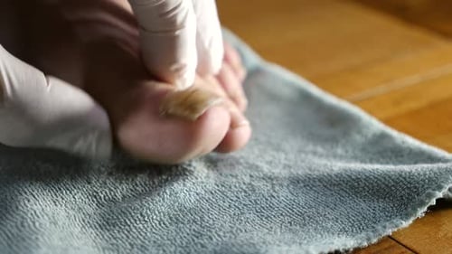 Examining Damaged Toenail on Foot with Gloves