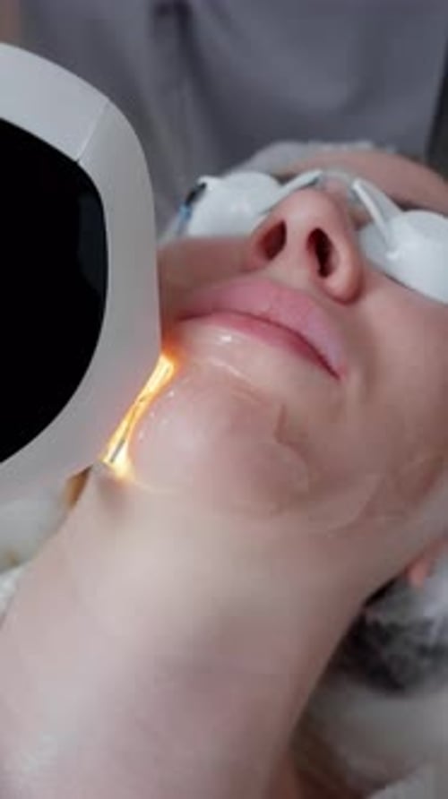 Woman Getting Laser Facial Procedure