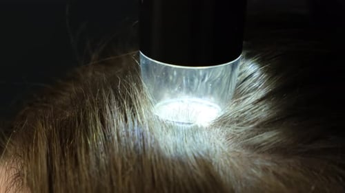 Trichoscopy of Hair and Scalp Closeup