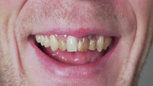 Man with bad teeth laughing, closeup