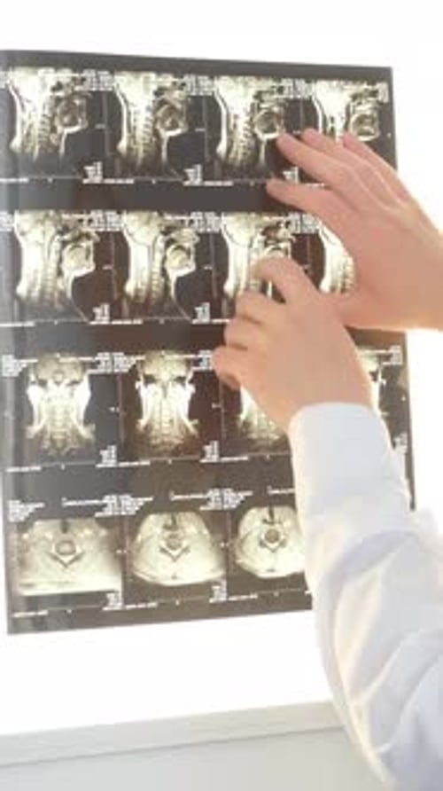 A Professional Vertebrologist Examines an Xray of a Female Patient's Spine in a Hospital