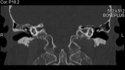 Coronal CT Computed Tomography scan layers of lower cranium and neck