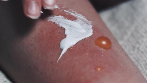 Applying Cream to Irritated Skin and Blister