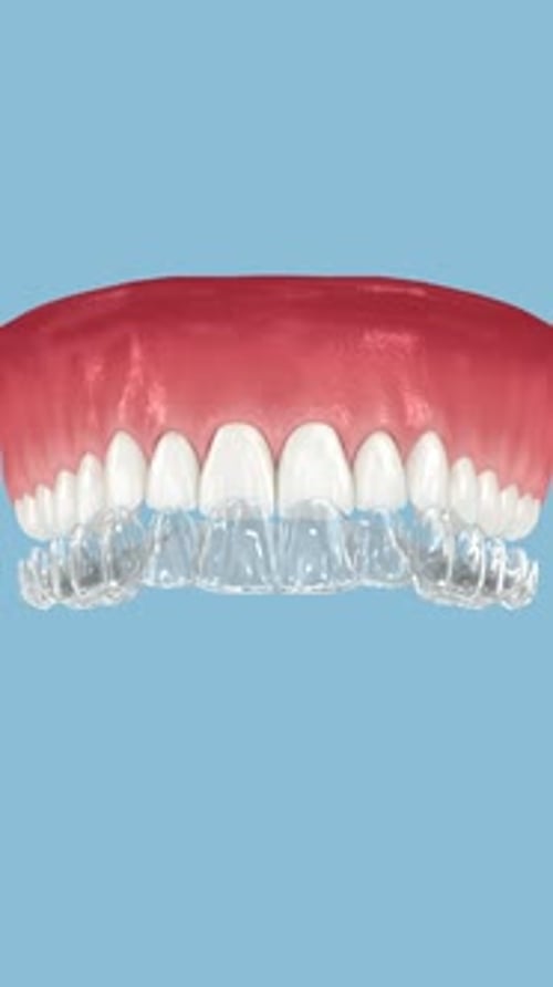 3D Animated Clear Dental Aligner Demonstration