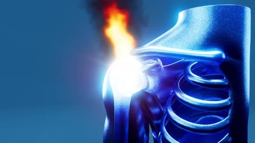 Conceptual 3D animation of shoulder inflammation on fire