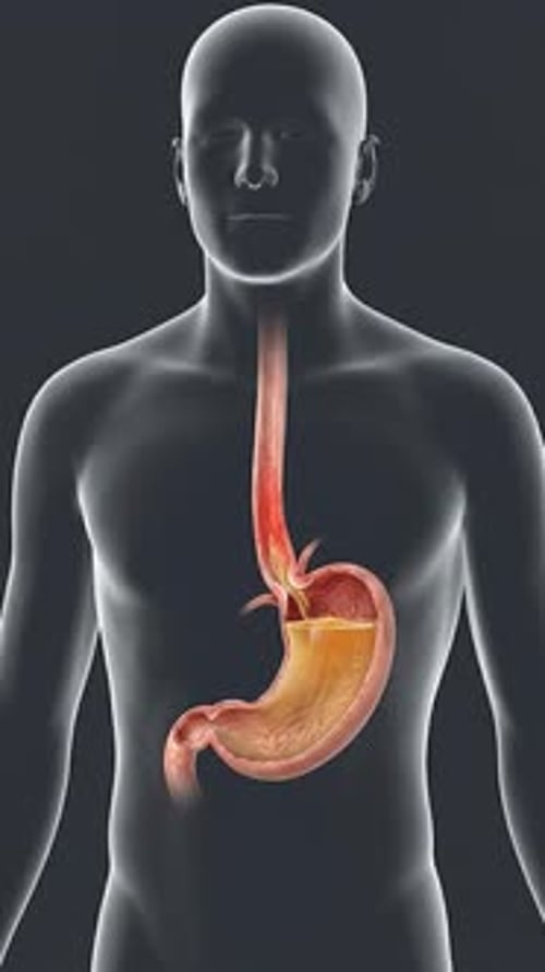 Acid Reflux - Gerd Esophageal Irritation 3 D Medical Animation | Manestream Den