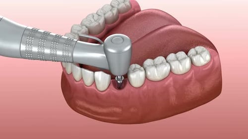 Dental Implant Placement Process 3D Animation
