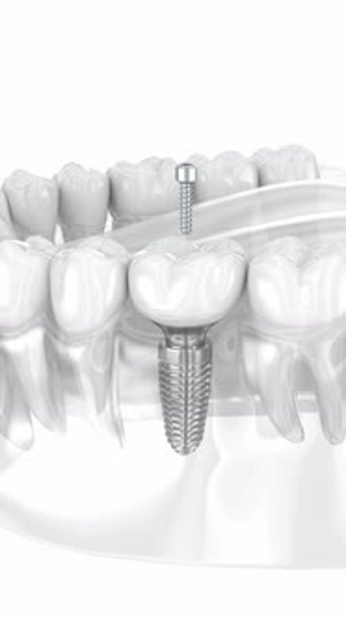 3D Animation of Dental Implant Installation in Human Jaw Bone