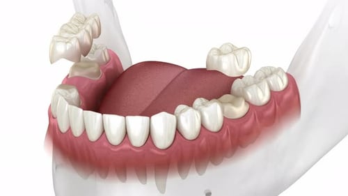 Installation of dental bridge and single crown