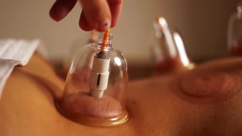 Cup therapy at spa. Chinese vacuum suction treatment for pain relief