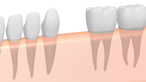 3D Dental Implant Installation Medical Animation