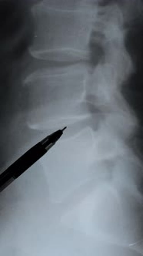 Hernia