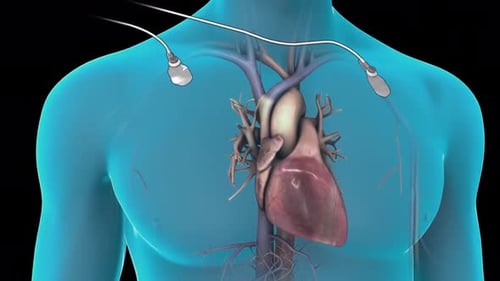 Medical Defibrillation of Human Heart with Electrodes Animation