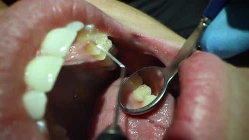 Dental Care Extreme Close Up Macro Video Dentist Treat Patient Teeth Orthodontist Works with
