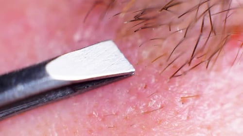 4K Super macro shot of hair removal with tweezers, on a caucasian person, at an extreme close up, in