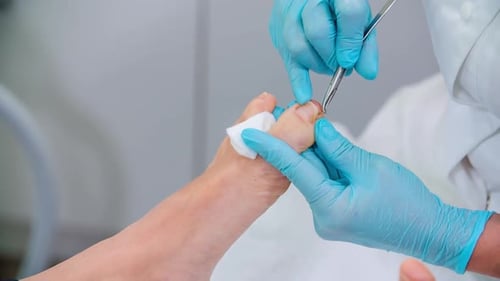 Pedicure specialist carefully takes care of ingrown toenail with cuticle nipper