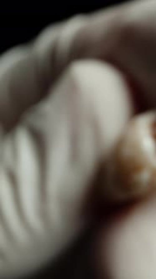 Vertical video. Hand in a White Medical Glove Examines a Bloodied Human Tooth, Close-up.